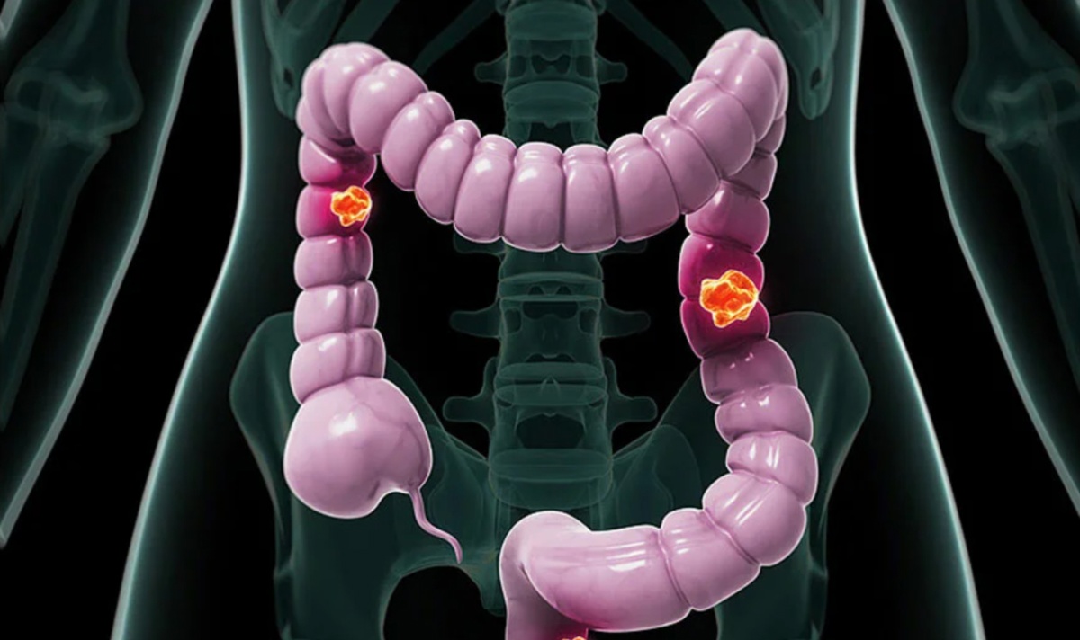 Скрытая угроза: как не прозевать рак прямой кишки?